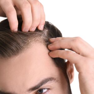 Dandruff(or) Hairfall Treatment for Men - Advance